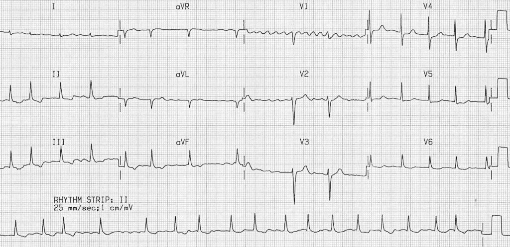 ECG Atrial Fibrillation coarse flutter waves