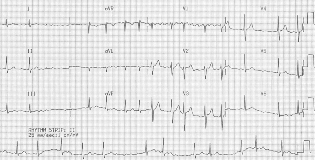 ECG Atrial Fibrillation coarse flutter waves 2 2