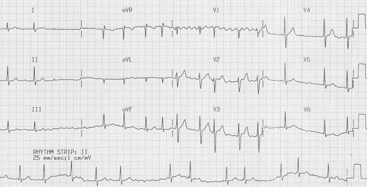 paroxysmal atrial fibrillation ecg