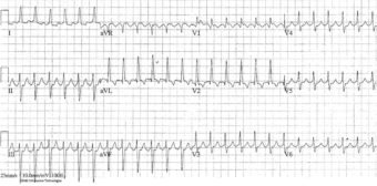Atrial Flutter • LITFL • ECG Library Diagnosis