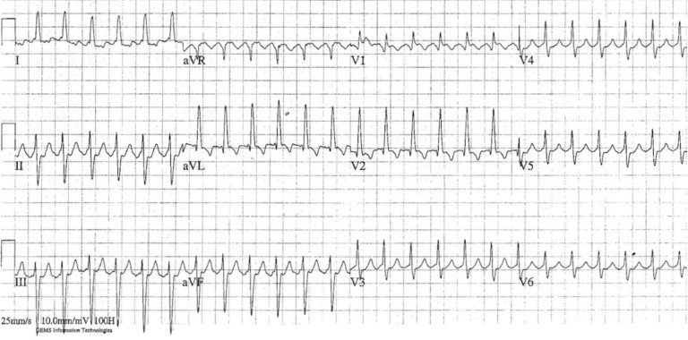 Atrial Flutter • LITFL • ECG Library Diagnosis