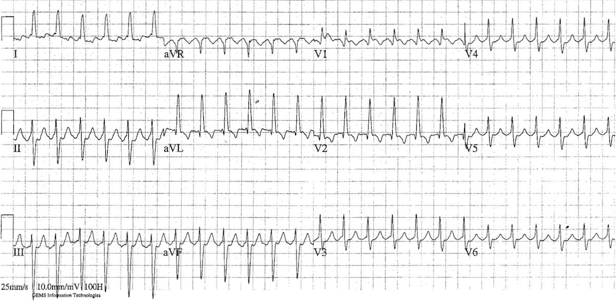 2 1 atrial flutter