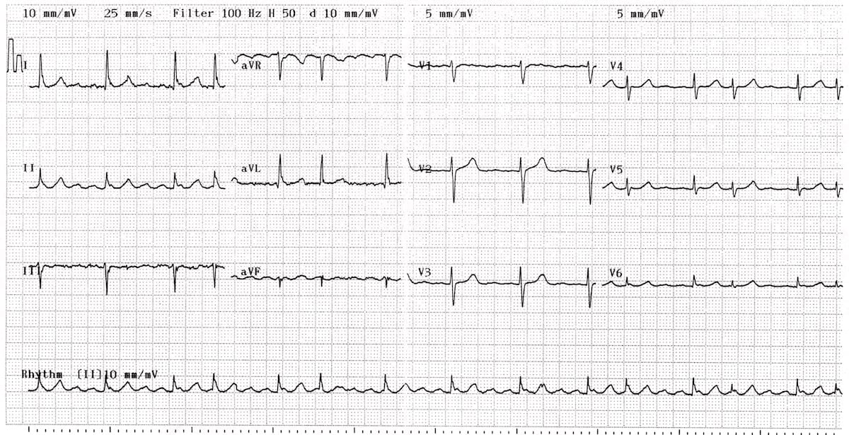 Atrial Flutter Variable Block