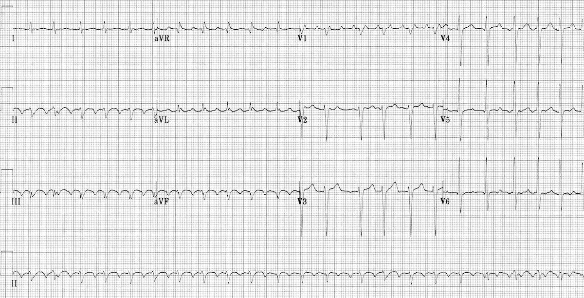 typical atrial flutter and ecg