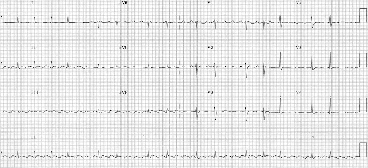 atrial flutter 2 to 1 conduction