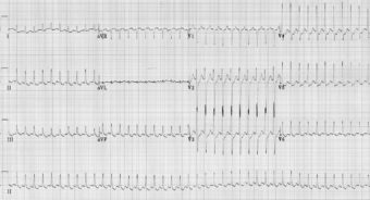 Atrial Flutter • LITFL • ECG Library Diagnosis