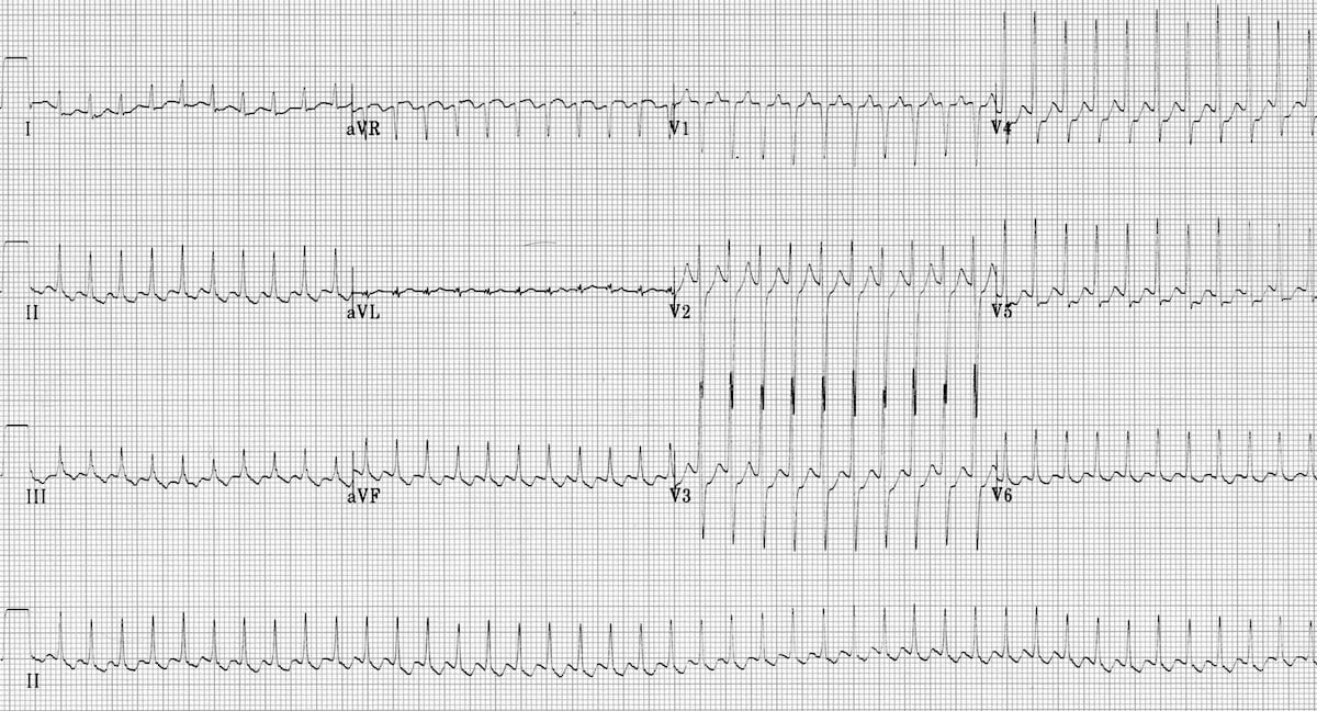 Atrial Flutter With Variable Block