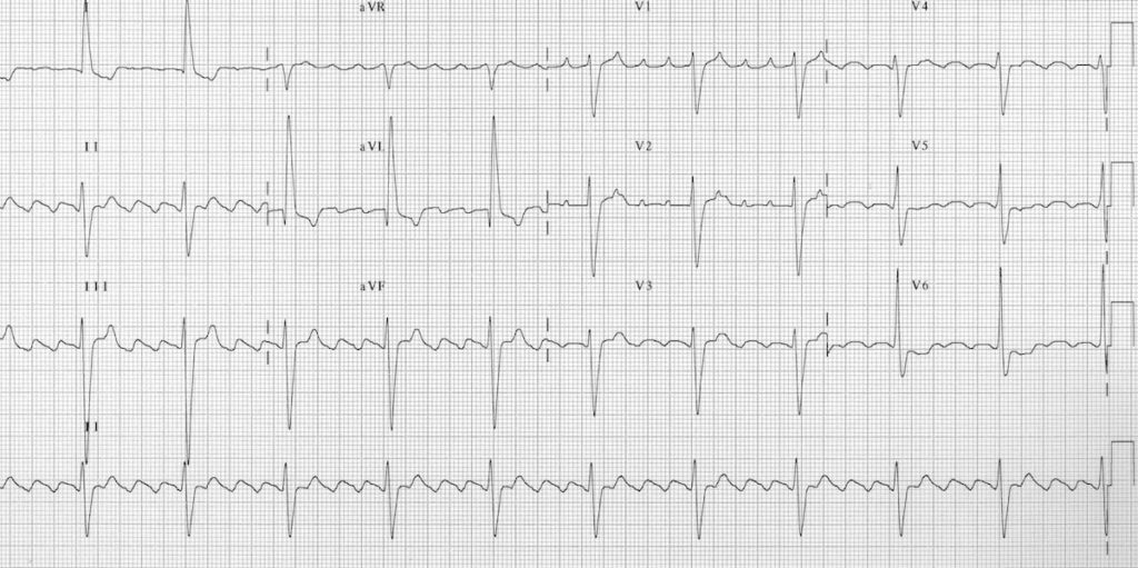 Atrial flutter with 4:1 block