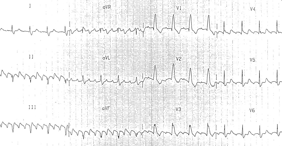 a flutter regular or irregular