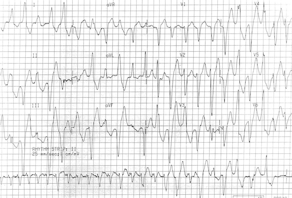 ECG Bidirectional Ventricular Tachycardia BVT 3