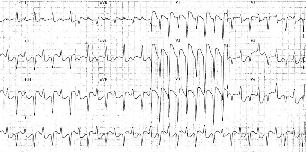 ECG Bidirectional ventricular tachycardia