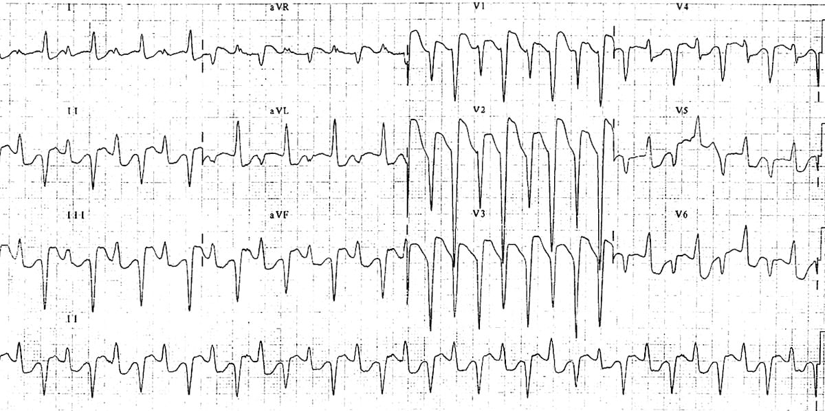 digitalis ecg