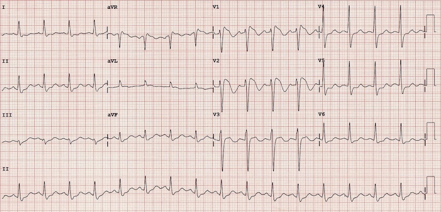 Brugada Syndrome • Litfl • Ecg Library Diagnosis