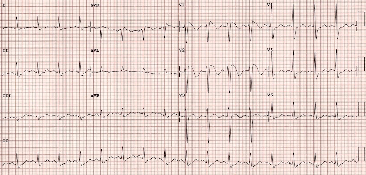 Right Bundle Branch Block