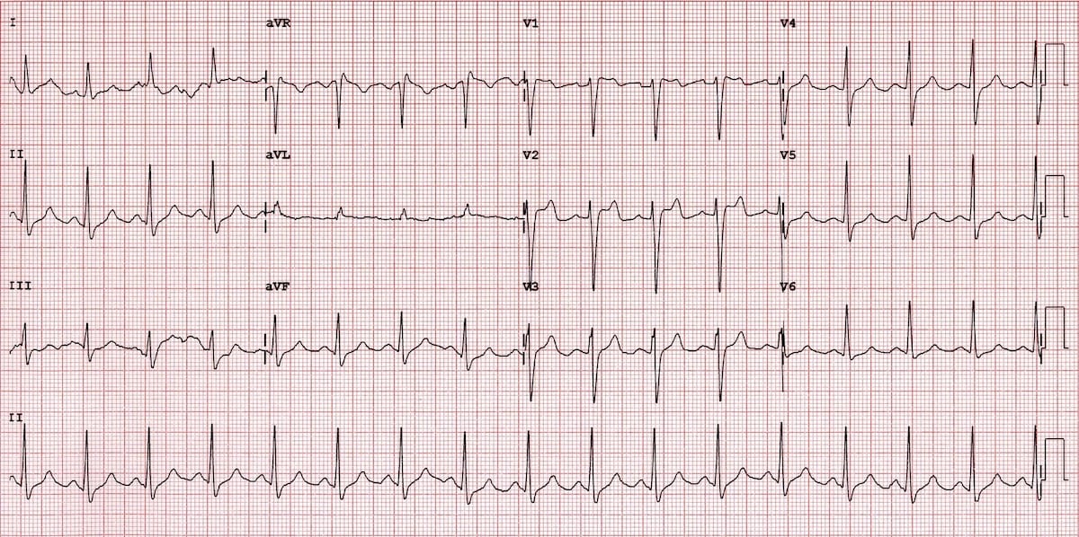 Ventricular Tachycardia and Bradycardia Jeopardy Template