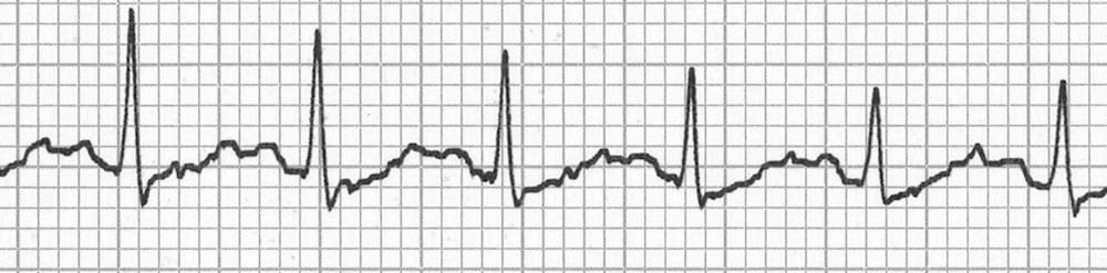 Sinus Tachycardia Litfl Ecg Library Diagnosis