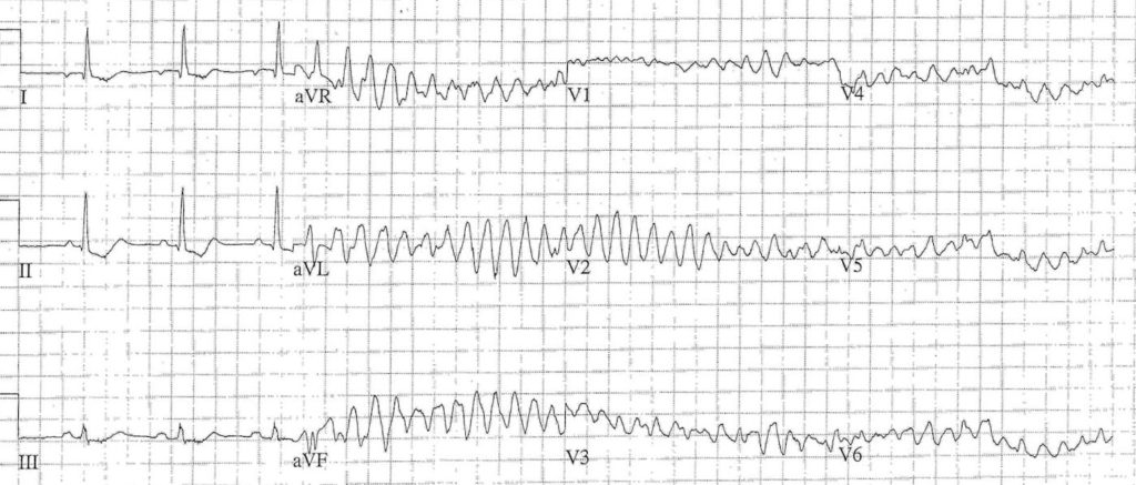 ECG Case 072