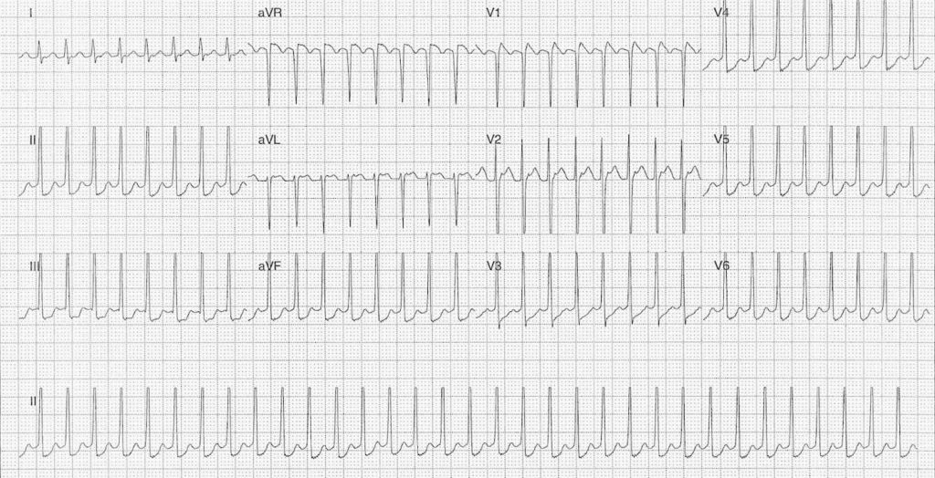 ECG Case 082 LITFL Top 100 EKG