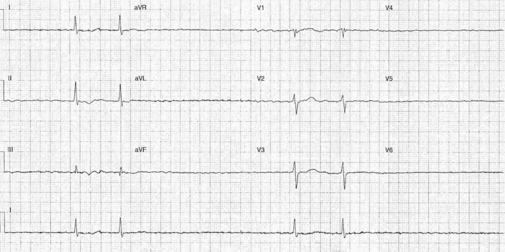 ECG Case 086 LITFL Top 100 EKG