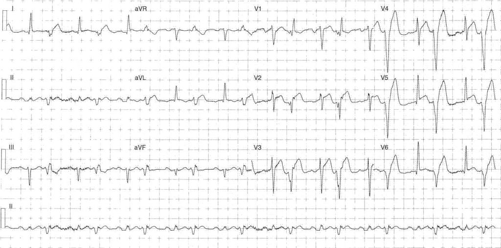 ECG Case 089a LITFL Top 100 EKG