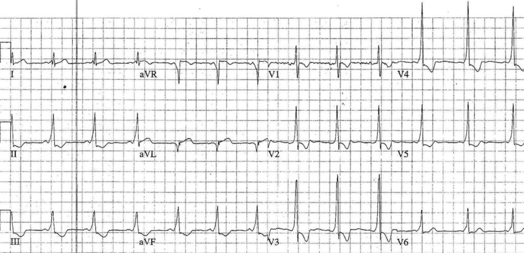 ECG Case 092a LITFL Top 100 EKG