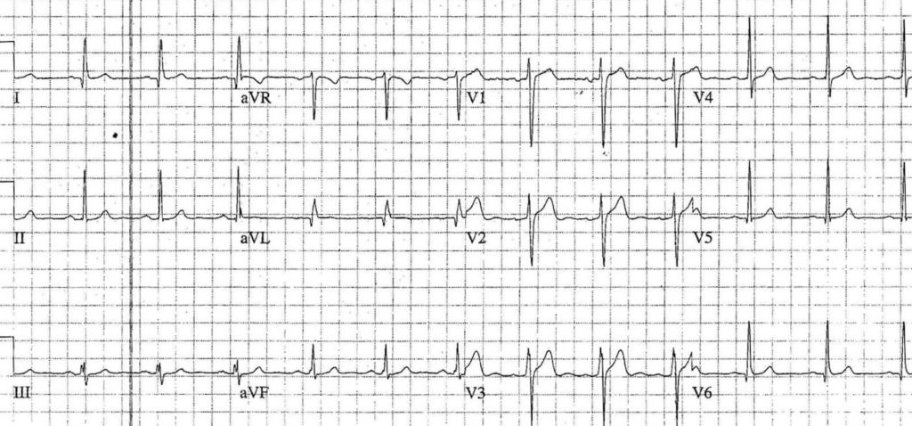 ECG Case 092b LITFL Top 100 EKG