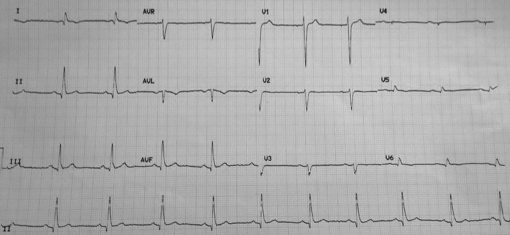 ECG Case 095 LITFL Top 100 EKG