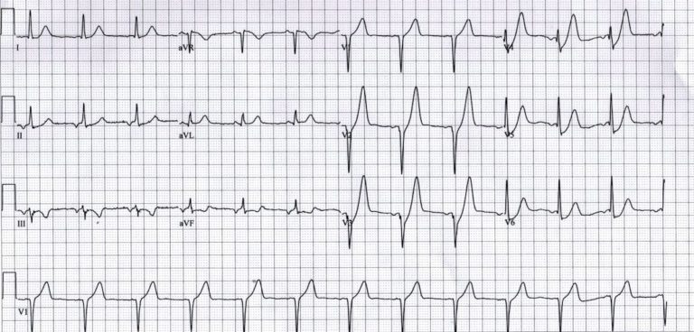 De Winter T Wave LITFL ECG Library Diagnosis