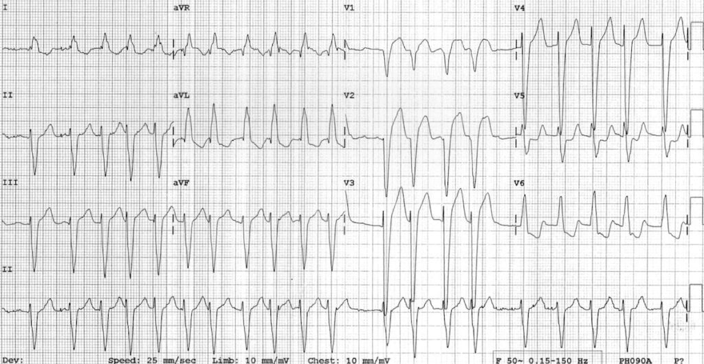 ECG Dilated cardiomyopathy Atrial fibrillation LBBB