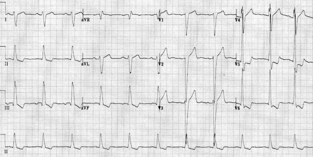 ECG Dilated cardiomyopathy Biventricular hypertrophy