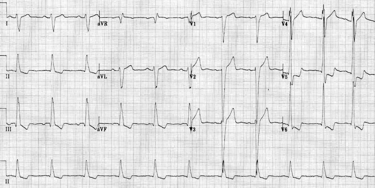 Dilated Cardiomyopathy Dcm • Litfl • Ecg Library Diagnosis 