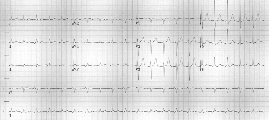 ECG Ectopic atrial tachycardia inverted p waves