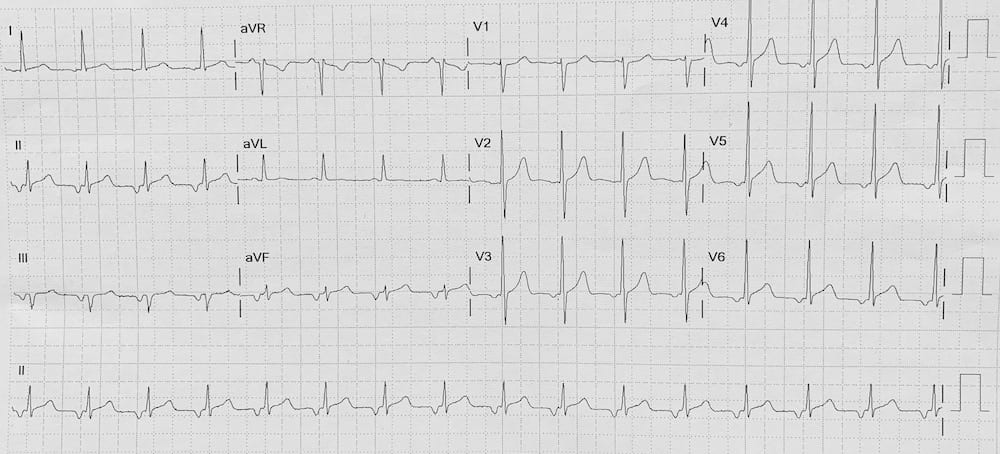 ectopic atrial tach