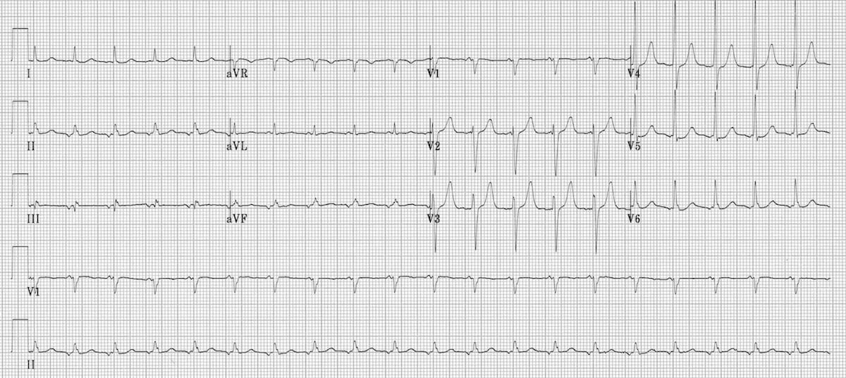 Focal Atrial Tachycardia Fat Litfl Ecg Library Diagnosis