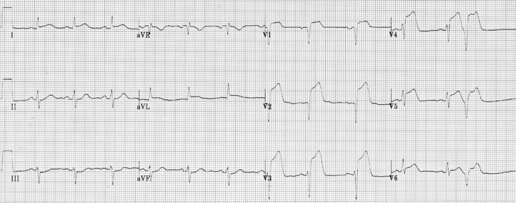 ECG Extensive Anterior STEMI (acute)