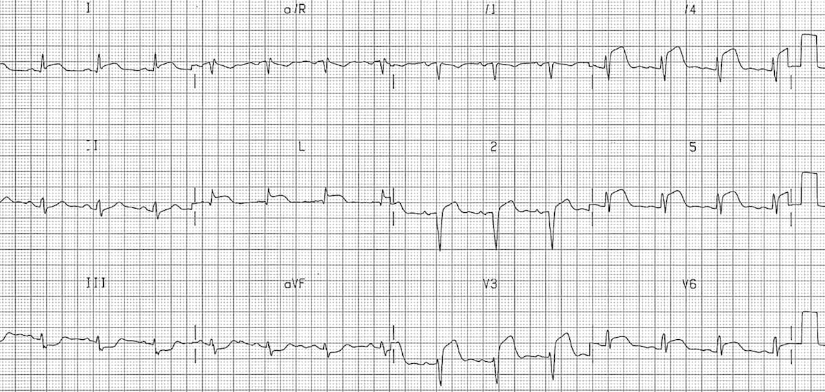 anterolateral-acute-myocardial-infarction-ecg