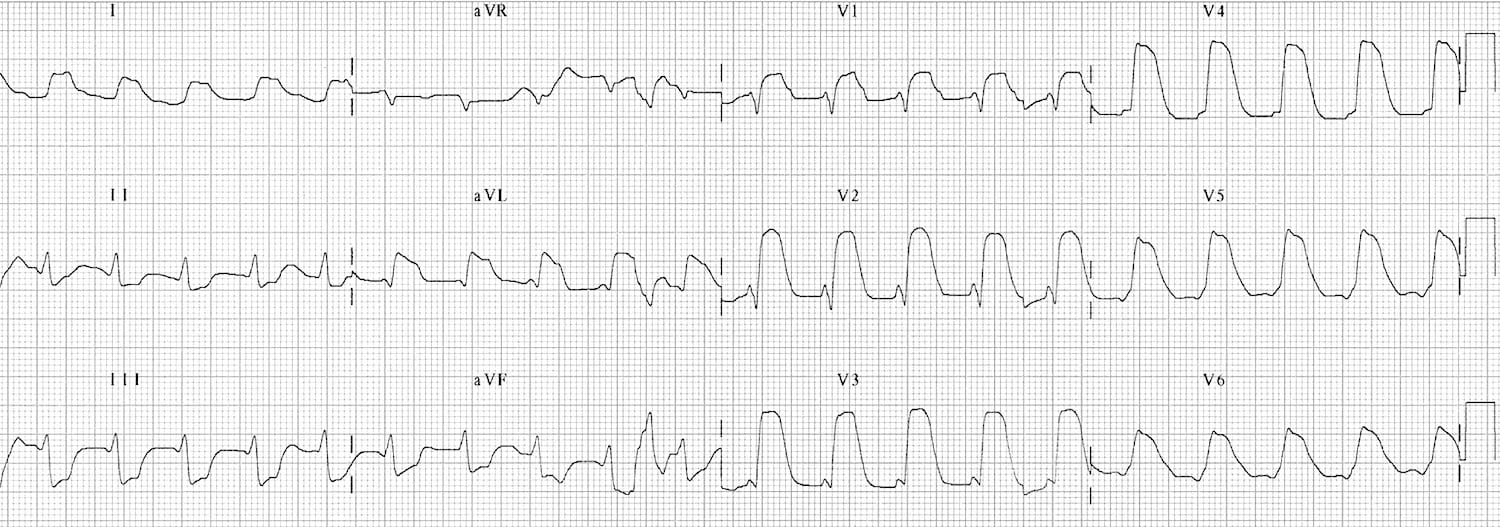 Old Anterior MI ECG