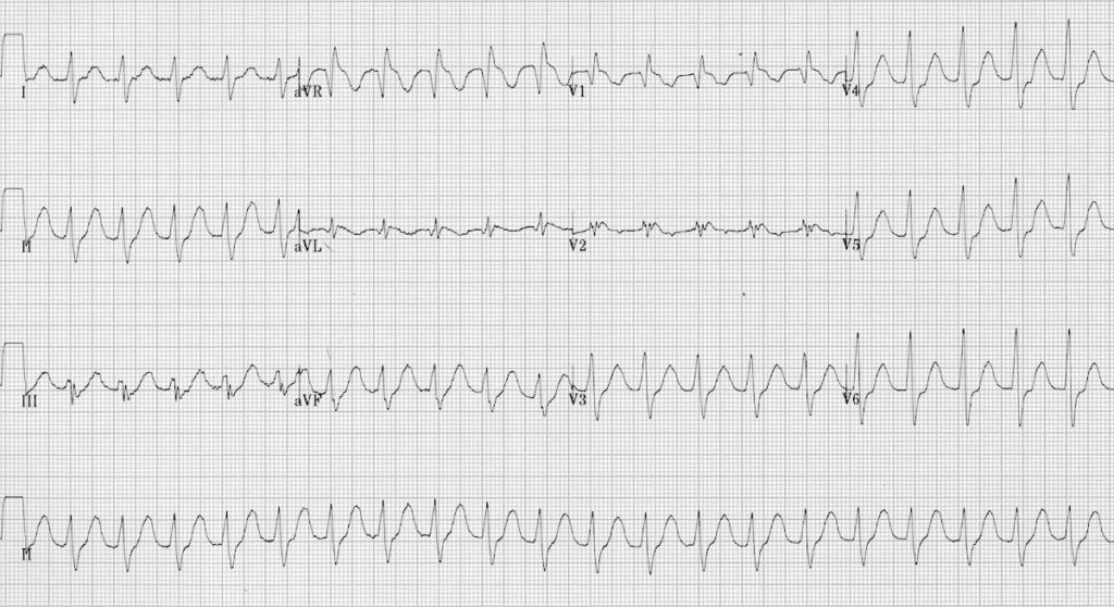 ECG Flecainide toxicity 1 2