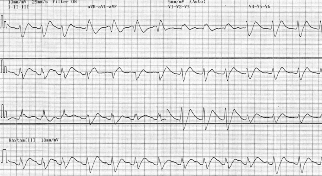 ECG Flecainide toxicity 3