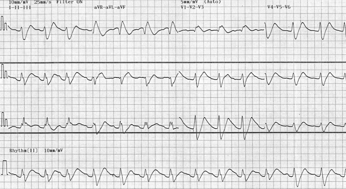 Propranolol 40mg od