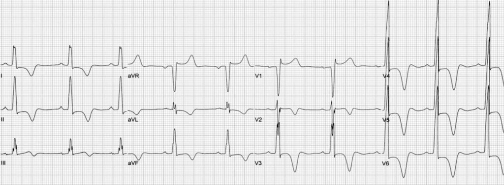 ECG HCM Apical