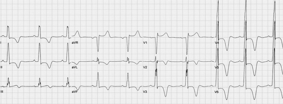 Apical Hypertrophic Cardiomyopathy Symptoms