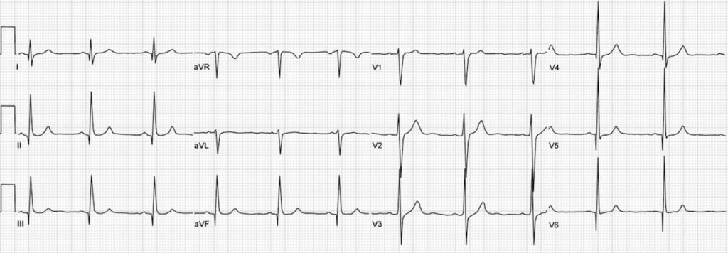 Hypertrophic Cardiomyopathy Hcm • Litfl • Ecg Library Diagnosis