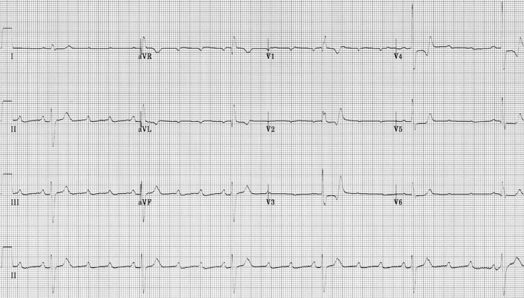 ECG High Grade AV block 4 to 1 AV block