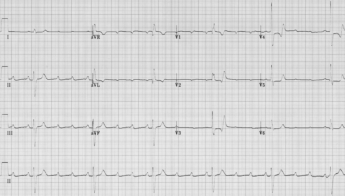 Av Block 2nd Degree High Grade Av Block Litfl Ecg Library