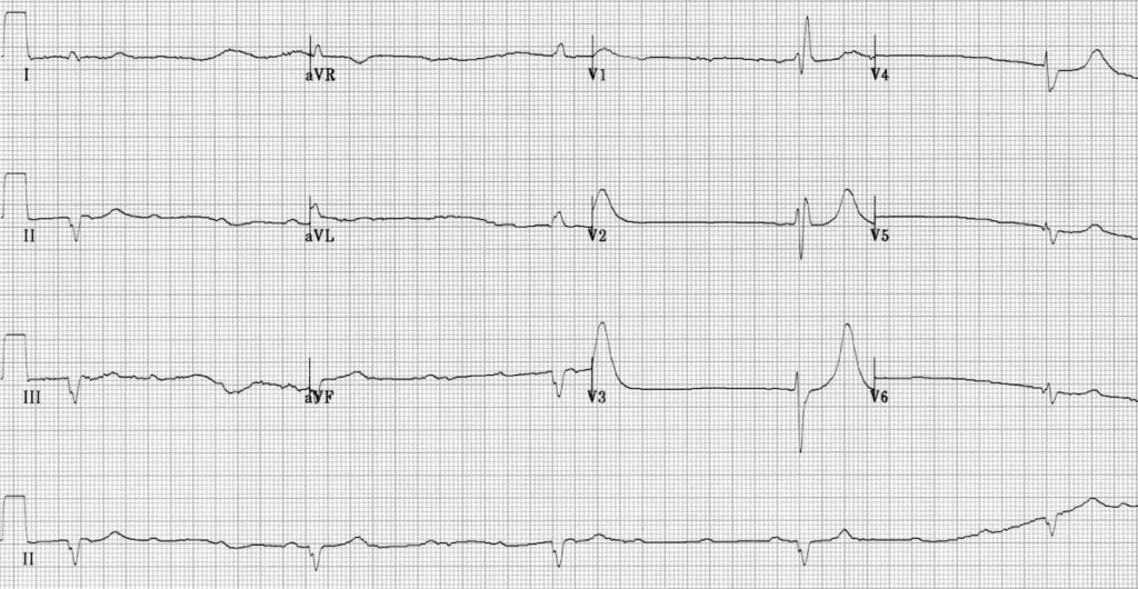 ECG High grade block CHB