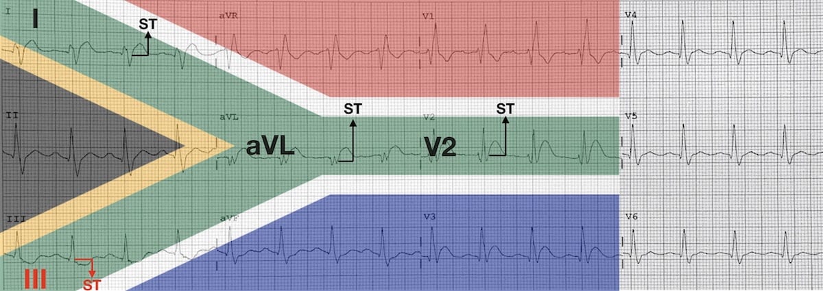 ECG High lateral STEMI 3 South African Flag sign