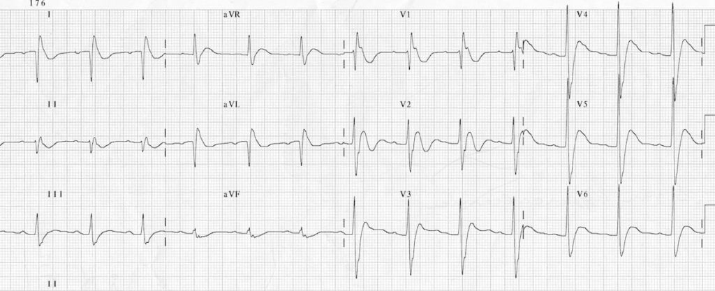 ECG Hypercalcaemia 2