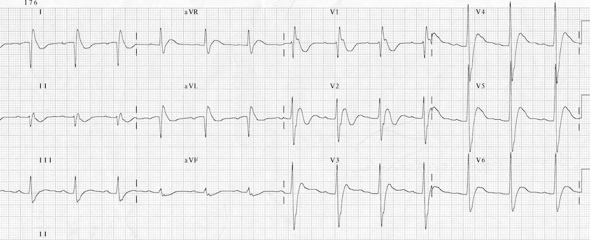 Hypercalcaemia ECG changes • LITFL • ECG Library