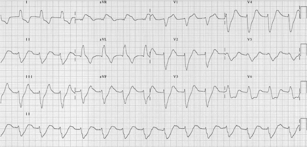 ECG Hyperkalemia broad QRS